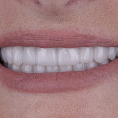 after dental care treatment