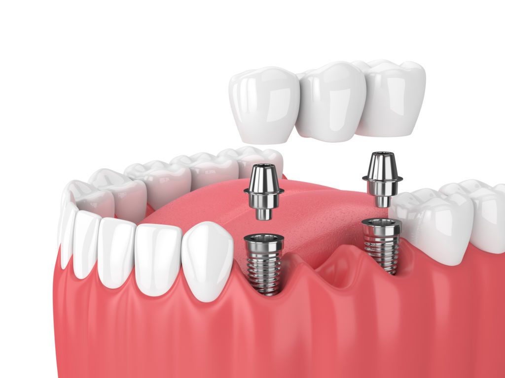 implant-supported dental bridge in Annapolis, MD