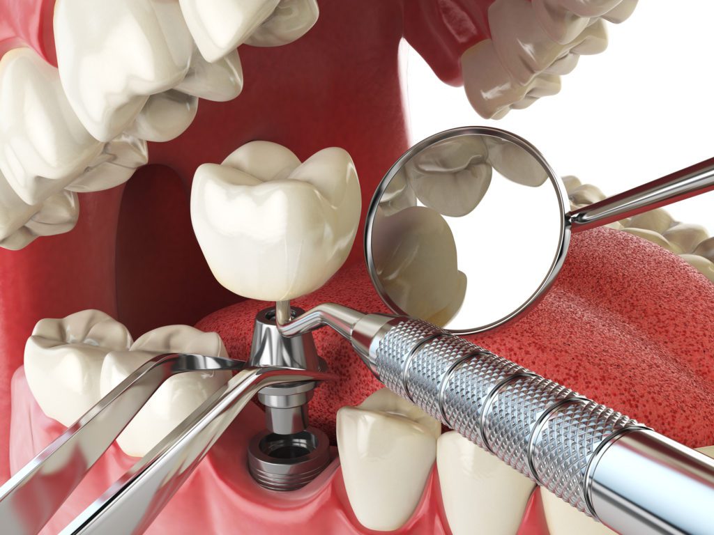 Dental Implant in Annapolis, Maryland