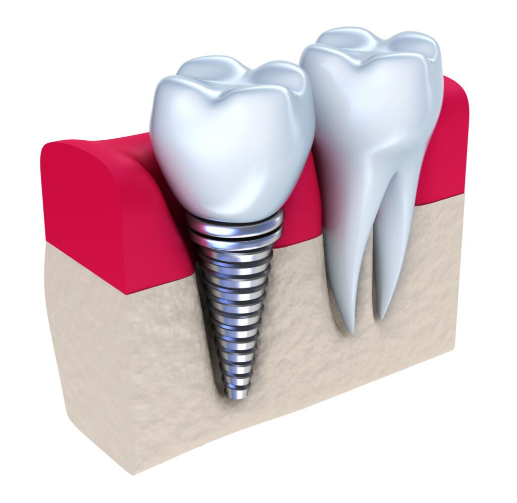 implant supported crown in Annapolis, MD