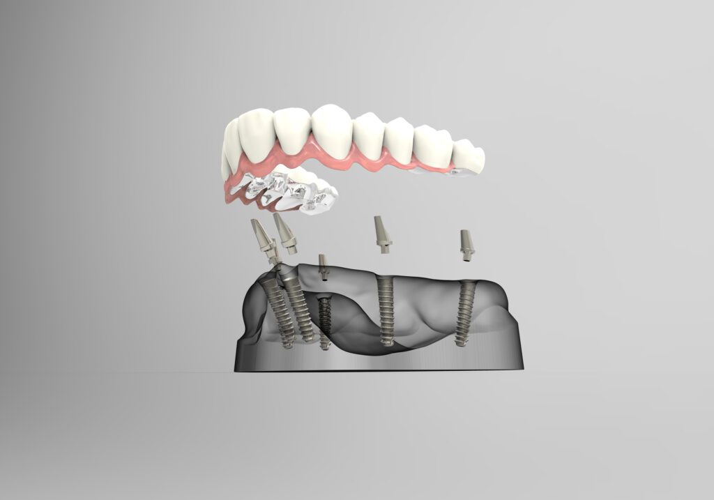 implant-supported dentures in Annapolis, MD