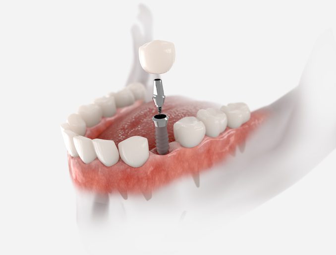 The cost of dental implants in Annapolis, MD
