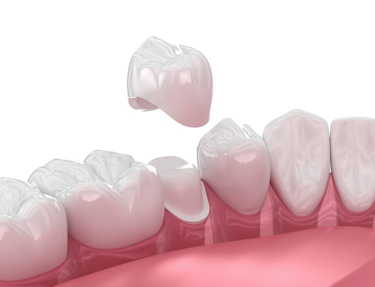 Understanding how to look after your new dental crown helps ensure a comfortable recovery and secure bite.